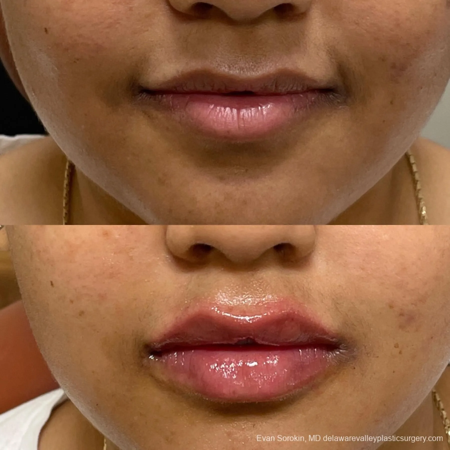 Lip Filler Before & After Gallery