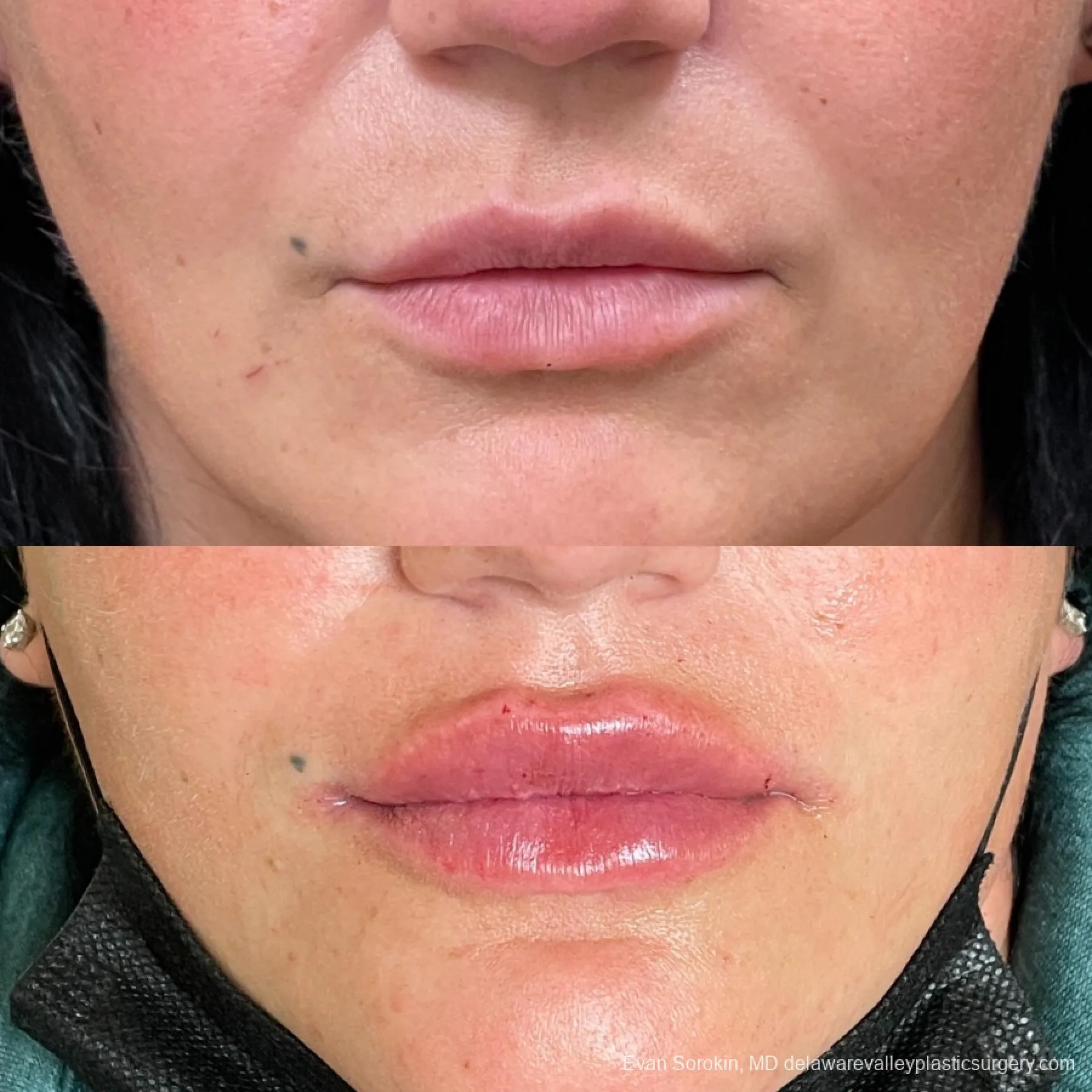 Lip Filler Before & After Gallery