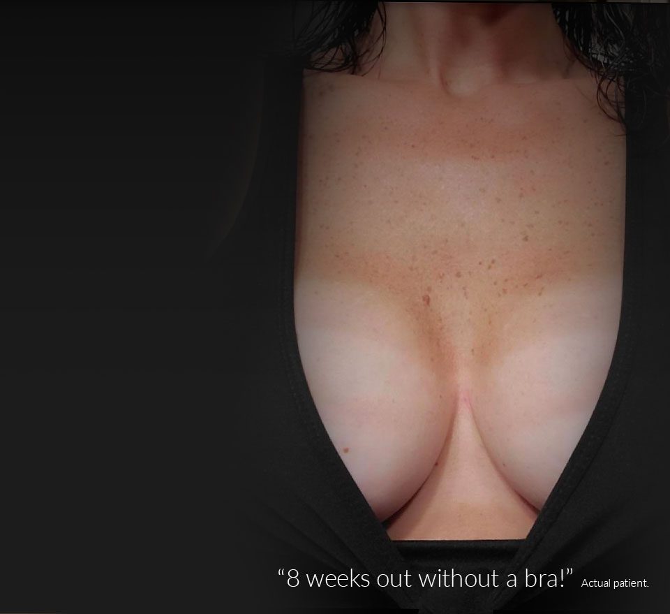 "8 weeks out, without a bra!" - Actual Philadelphia Breast Augmentation Patient