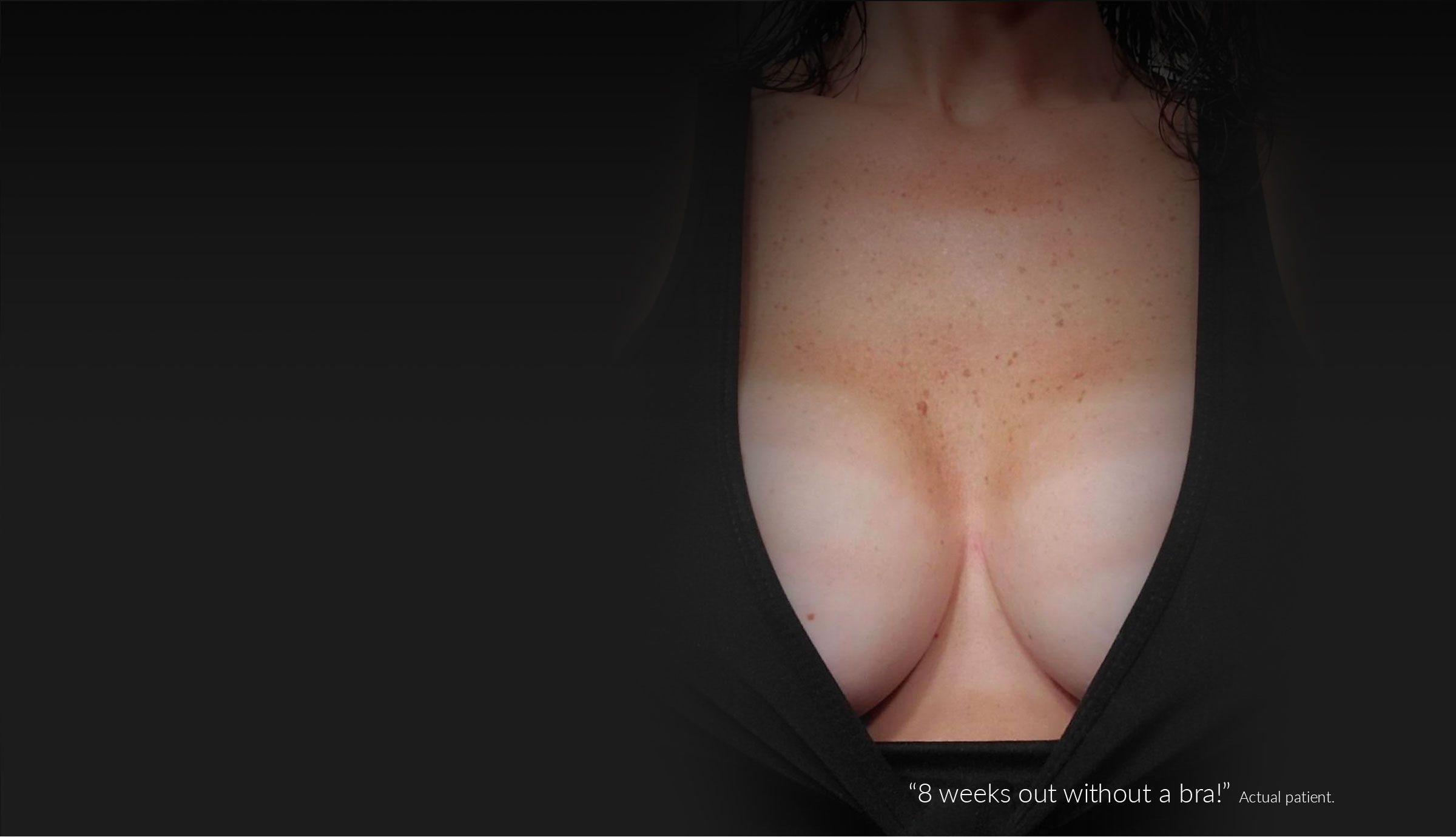 "8 weeks out, without a bra!" - Actual Philadelphia Breast Augmentation Patient