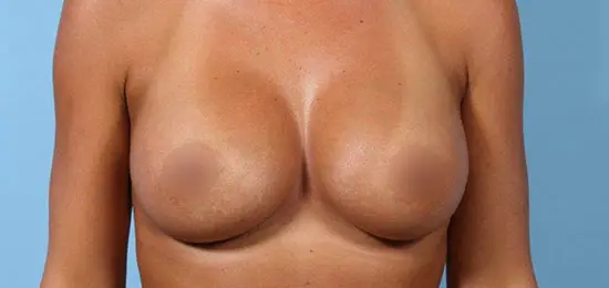 philadelphia breast augmentation after front 9404
