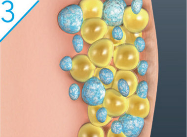 CoolSculpting Step 3: Frozen Fat Eliminated