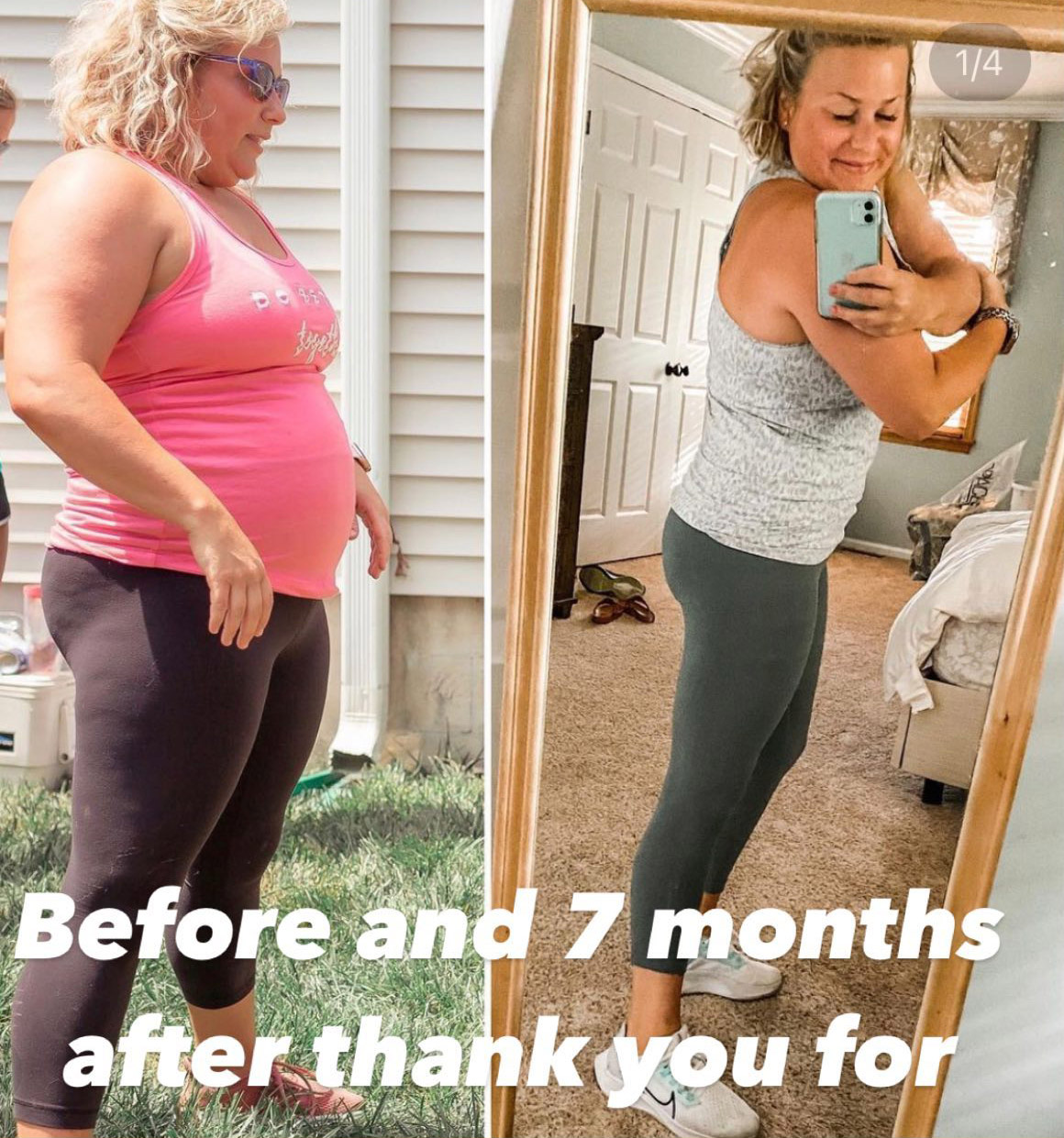 mommy makeover 7 months after