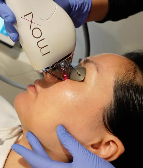 moxi laser resurfacing cherry hill