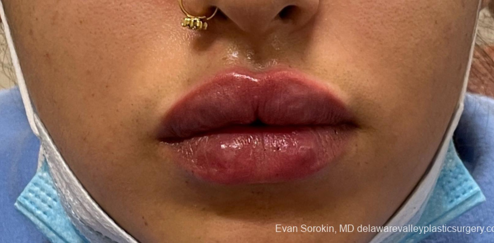 sorokin lip augmentation 1 after