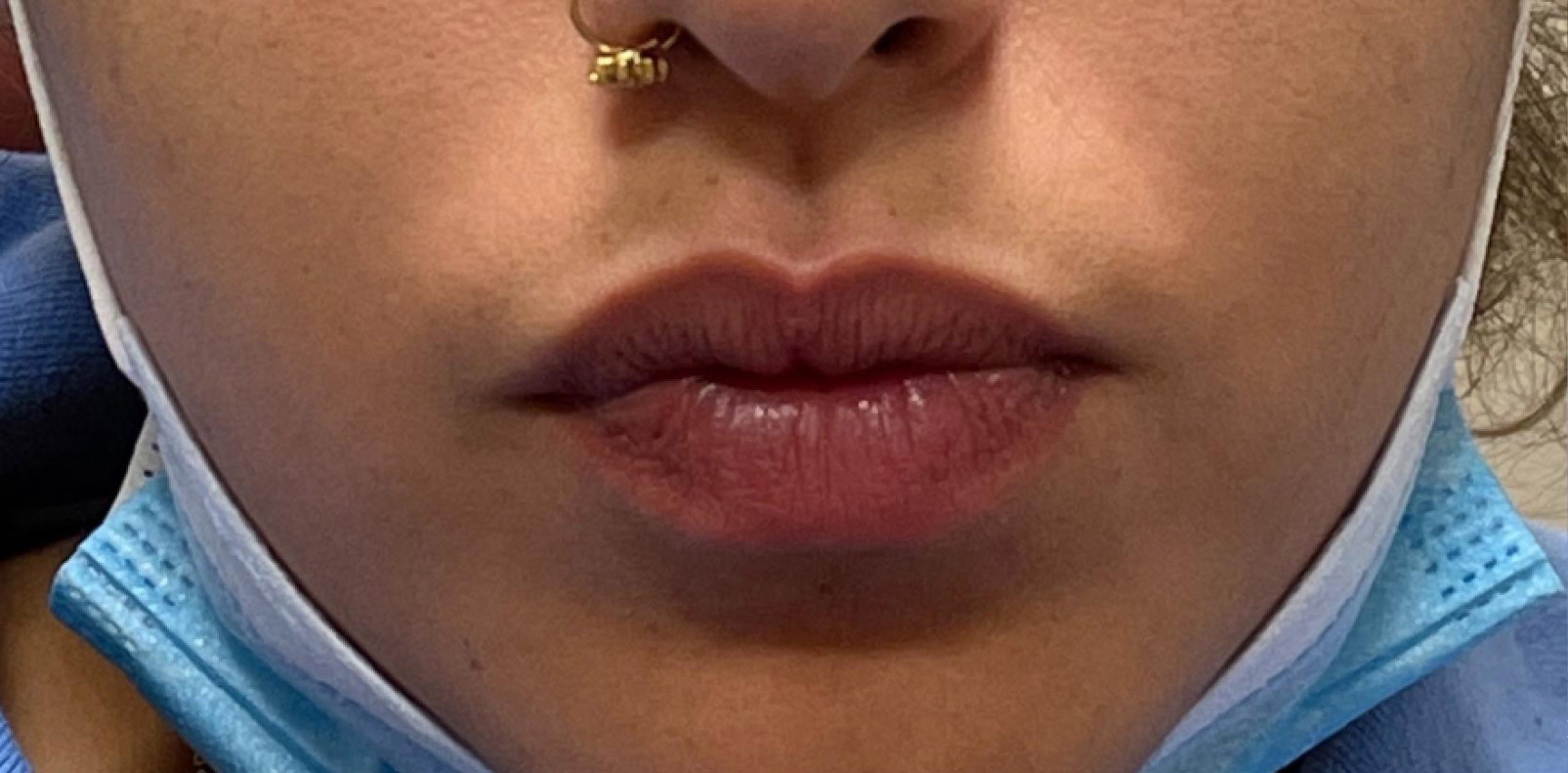 sorokin lip augmentation 1 before