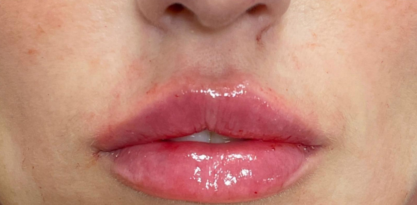 sorokin lip augmentation 2 after