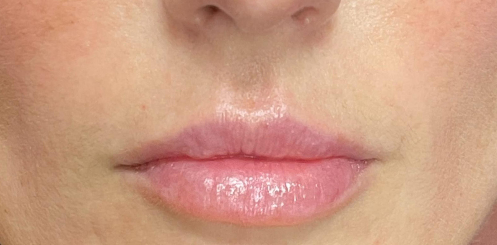 sorokin lip augmentation 2 before