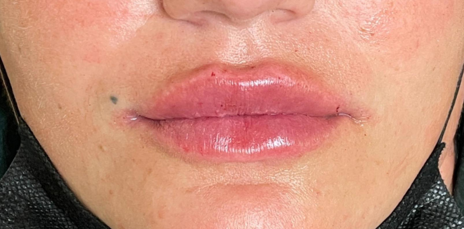 sorokin lip augmentation 3 after