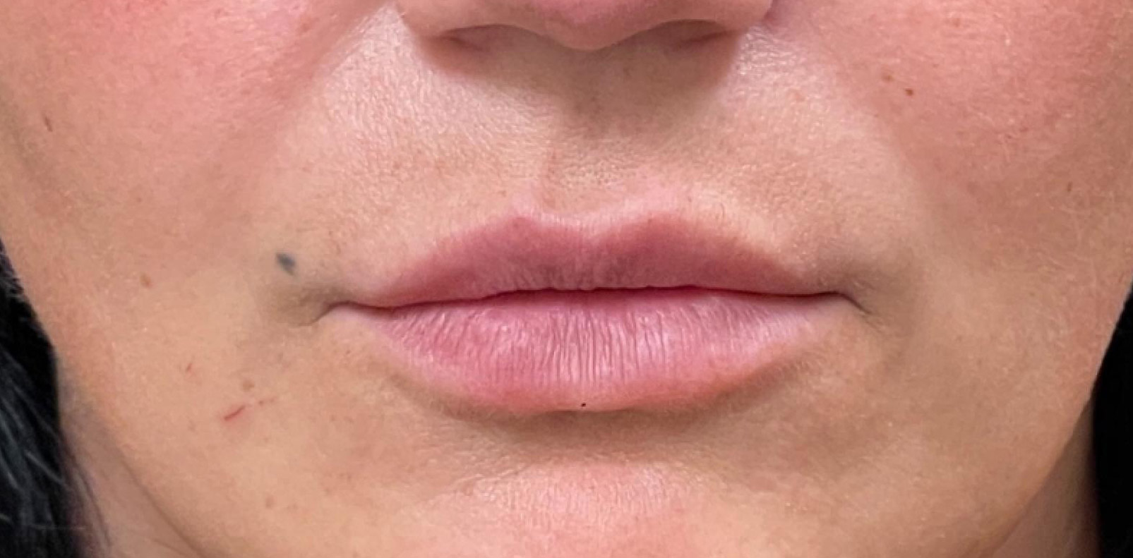 sorokin lip augmentation 3 before